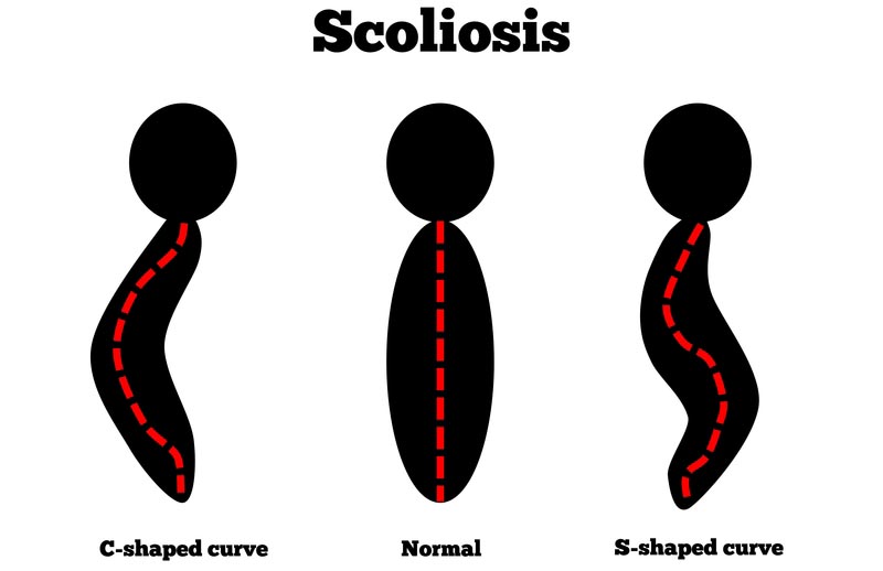 OIympia, WA scoliosis treatment
